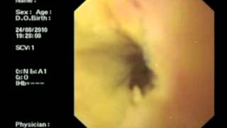 Habib EndoHPB  Endoscopic Intraductal RF Ablation of Cholangiocarcinoma by Dr Nagy Reddy [upl. by Enayr]