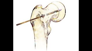 Percutaneous Cannulated Screw Fixation of Slipped Capital Femoral Epiphysis [upl. by Retla]