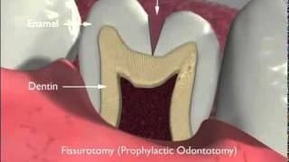 Dental Sealants and Fissurotomy [upl. by Ocir]