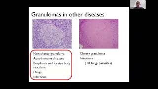 What Causes Sarcoidosis  Neurosarcoidosis Patient Day 2023 [upl. by Simone610]