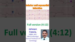 Inferior wall myocardial infarction [upl. by Lyckman]