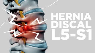 HERNIA DISCAL L5S1 síntomas y soluciones [upl. by Nahtaneoj]