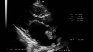 MS different aspectsmitral stenosis with LA thrombus [upl. by Yxel]