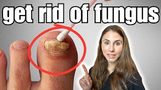 Get Rid Of Toenail Fungus With These 4 Easy Home Remedies [upl. by Fenella]