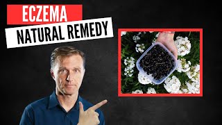 Best Natural Remedy for Eczema [upl. by Hyacinthe]