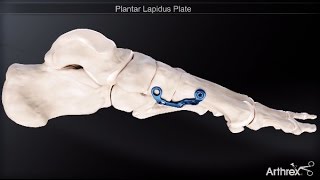 Plantar Lapidus Plate [upl. by Carley114]