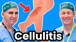 Cellulitis Explained By Infectious Disease Doc Red Sore And Swollen [upl. by Wernsman]