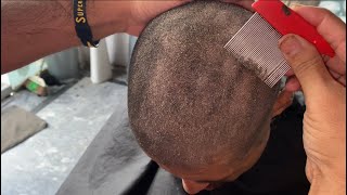 How to get rid old dandruff flakes scratching super care 🥵😱💯 how to get rid of dry scaly skin [upl. by Riedel]