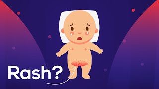 Diaper Rash Due to Baby Urine or Fungus amp Helpful tips to cure [upl. by Ellen]