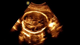 Routine antenatal ultrasound at 28 weeks gestation Ultrasonography of a 28week pregnancy [upl. by Reham]