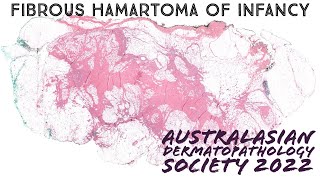 Fibrous hamartoma of infancy explained in 5 minutes pathology dermpath dermatology [upl. by Becky]