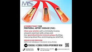 Clear Arterial Blockage With Atherectomy at MISS [upl. by Ardehs]