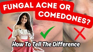 Fungal Acne VS Closed Comedones  Top 5  1 Practical Differences [upl. by Jp]