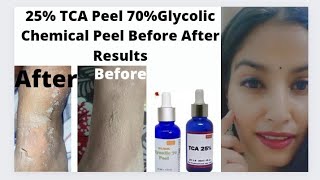 25 TCA peel 70 Glycolic peel Before After Results HandLegsBody Chemical peelIn Hindi [upl. by Zednanreh]