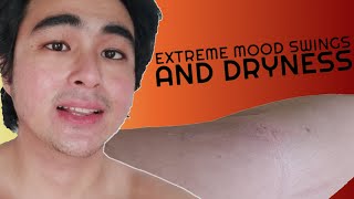 SIDE EFFECTS OF ISOTRETINOIN ACCUTANE ACNETREX❌❌❌  7th Month Progress Video  KevInSeries [upl. by Layla98]