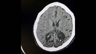 Bilateral chronic occipitoparietal infarctsDystrophic calcifications thickened adjacent calvarium [upl. by Neibaf552]