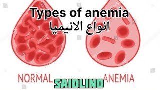 انواع الأنيميا شرح للطاقم الطبي Types of anemia [upl. by Lev894]