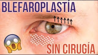 BLEFAROPLASTÍA SIN CIRUGÍA MEDIANTE LASER CO2 FRACCIONADO 💕 DR ALBERTO CALVO QUIROZ [upl. by Yard]