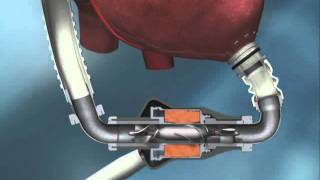 HeartMate II Left Ventricular Assist System  MyLVAD [upl. by Domingo]