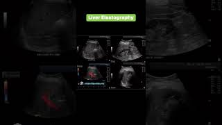 Liver Elastography [upl. by Ydnic]