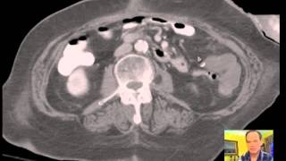 CT Abdomen and Pelvis BLOOD VESSELS  Vascular Anatomy Discussion [upl. by Scrivings]