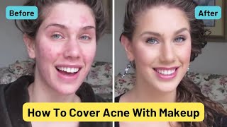 Foundation Routine For Acne  How To Cover Pimples Scars Cystic Acne Blackheads amp Oil [upl. by Hi330]