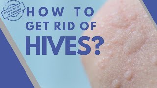 Dermatologists 1 Tip to Banish Hives Forever [upl. by Pruchno956]