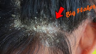 Removal Dandruff Flakes With Lice Comb Psoriasis Flakes Scalp Easy Scratching Dandruff Off Scalp [upl. by Fiester172]