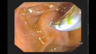 Large CBD stone  Biliary stenting [upl. by Eninaj900]