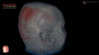 Resection of Brain Stem Cavernoma Minimally Invasive Surgery [upl. by Amaryllis198]