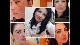 Diário Tratamento contra melasma 1 [upl. by Sankaran]