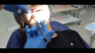 How to do dental anesthesia [upl. by Randell]