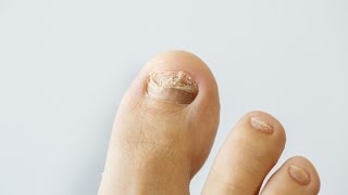 How to prevent and treat nail fungus [upl. by Oynotna89]