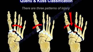 Lisfranc Injuries  Everything You Need To Know  Dr Nabil Ebraheim [upl. by Suravat]