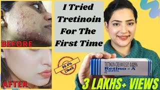 Retino A 0025cream Review  Before And After Tretinoin Cream Review  My experience with Tretinoin [upl. by Ymmat]