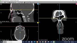 Sinonasal polyposis  Functional Endoscopic Sinus Surgery  FESS   Dr Satish Jain [upl. by Ahgiela]