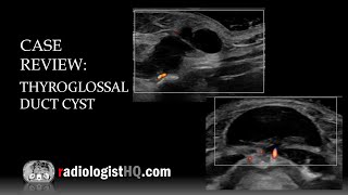 Ultrasound of Thyroglossal Duct Cyst [upl. by Zulaledairam707]