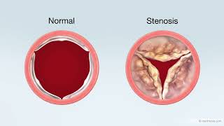 Transcatheter Aortic Valve Replacement TAVR Treatment for Aortic Stenosis [upl. by Boland]