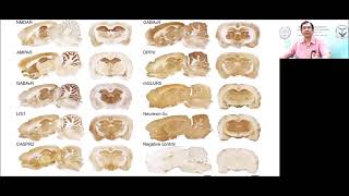 Autoimmune encephalitis  Dr Vivek Mathew [upl. by Hunger]