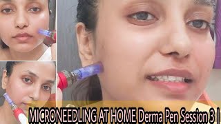 MICRONEEDLING AT HOME Derma Pen Session 3  Before amp After result 2023 [upl. by Beal]