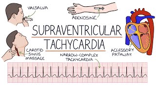 Understanding Supraventricular Tachycardia SVT [upl. by Aicital]