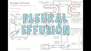 Pleural effusion  Internal medicine Etiology Clinical Features Diagnosis and Treatment Usmle [upl. by Cuthbert]