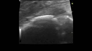 sonographic appearance of discospondylitis in a dog [upl. by Annoirb461]