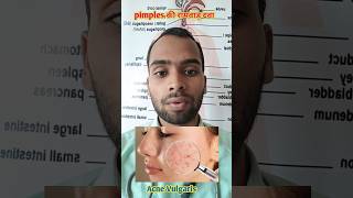 Pimples  Acne Vulgaris Homoeopathic Treatment [upl. by Ennovyhc]