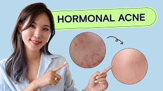 How To Treat Hormonal Acne  Acne School EP03 Health [upl. by Aliber577]