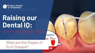 What are the Stages of Gum Disease  Western Dental [upl. by Konyn]