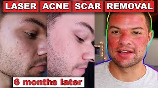 Acne Scar Removal Before And After 6 Months Fractional C02 Laser Skin Resurfacing [upl. by Phionna]