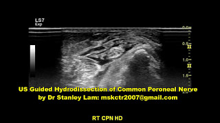 Ultrasound Guided Hydrodissection of Common Peroneal Nerve [upl. by Aicekat]