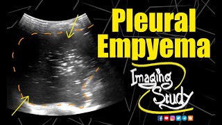 Pleural Empyema  Ultrasound  Case 156 [upl. by Porett681]