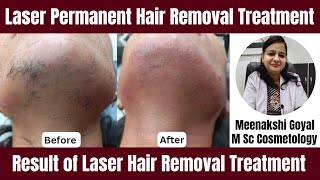 Laser Permanent Hair Removal Treatment  Result and Procedure [upl. by Carlee534]